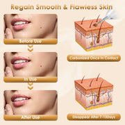Portable Skin Tag Remover Pen with LED Light 9 Intensity Gears Cordless Rechargeable Skin Tag Removal Kit Intended for Common Warts Mole Skin Tags Gif